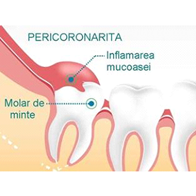 Pericoronarita